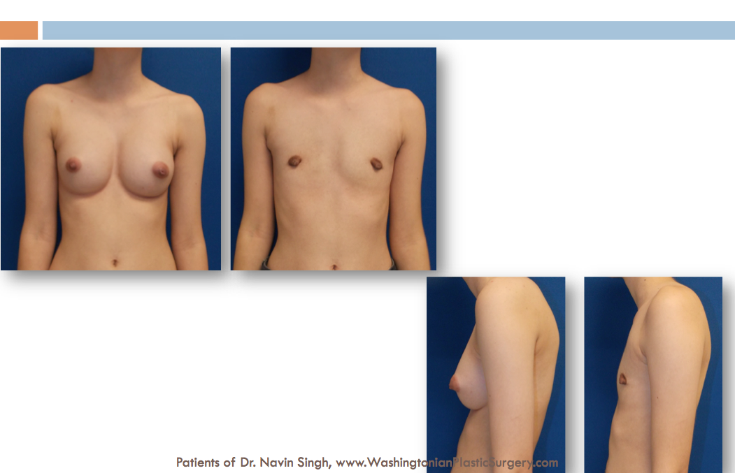 Mtf+Bottom+Surgery The differences of Gynecomastia or Breast Removal are significant